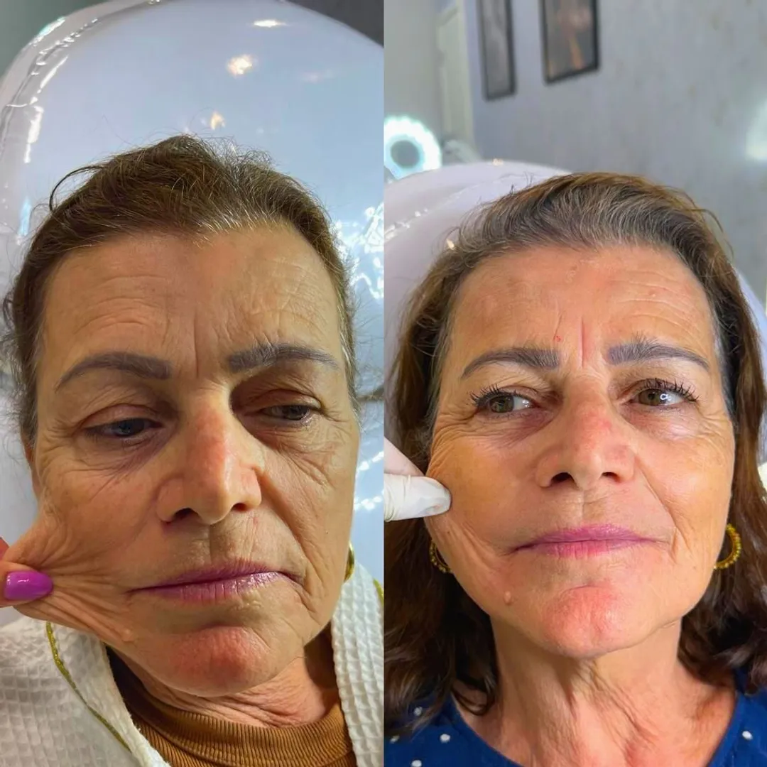 Bioestimulador facial