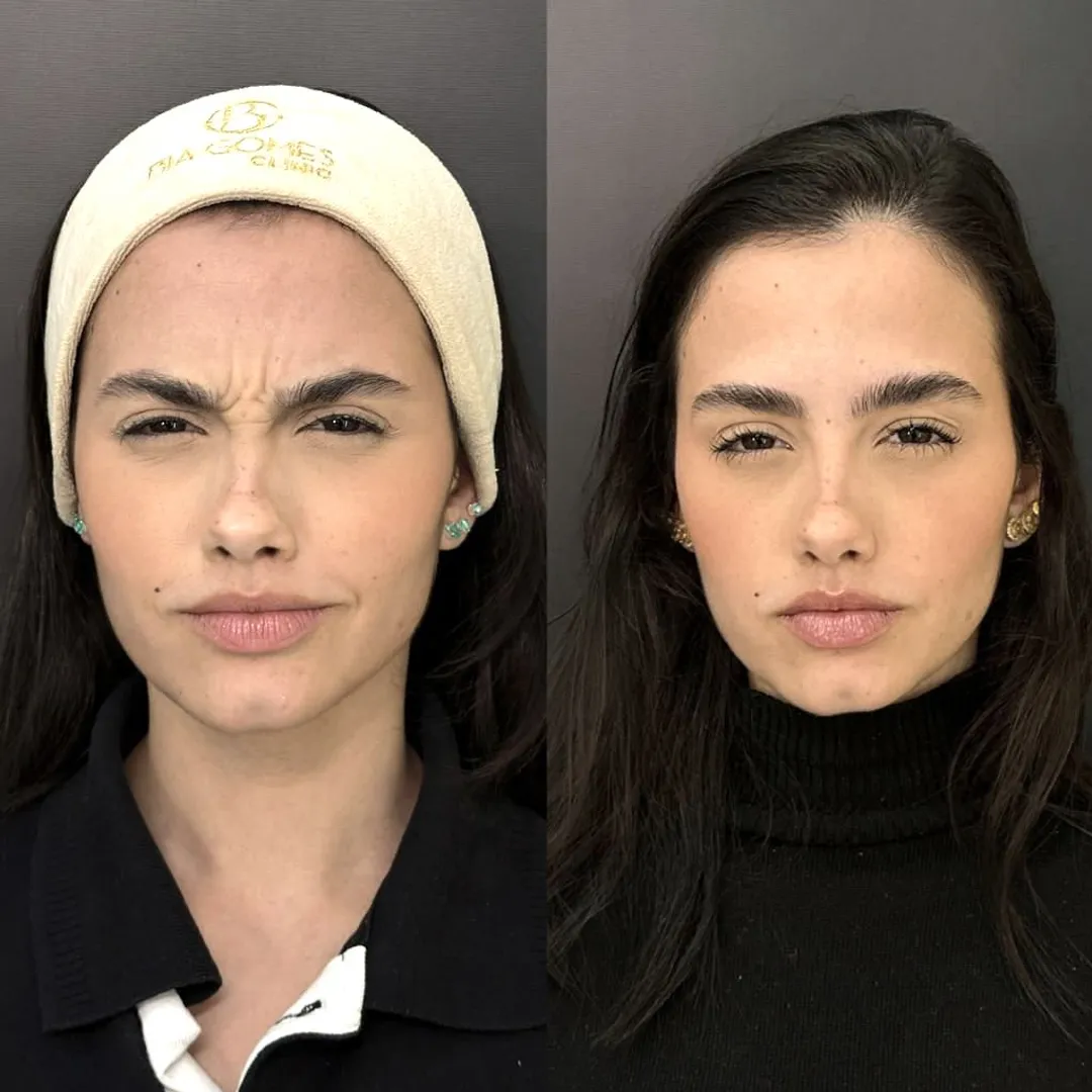 Botox