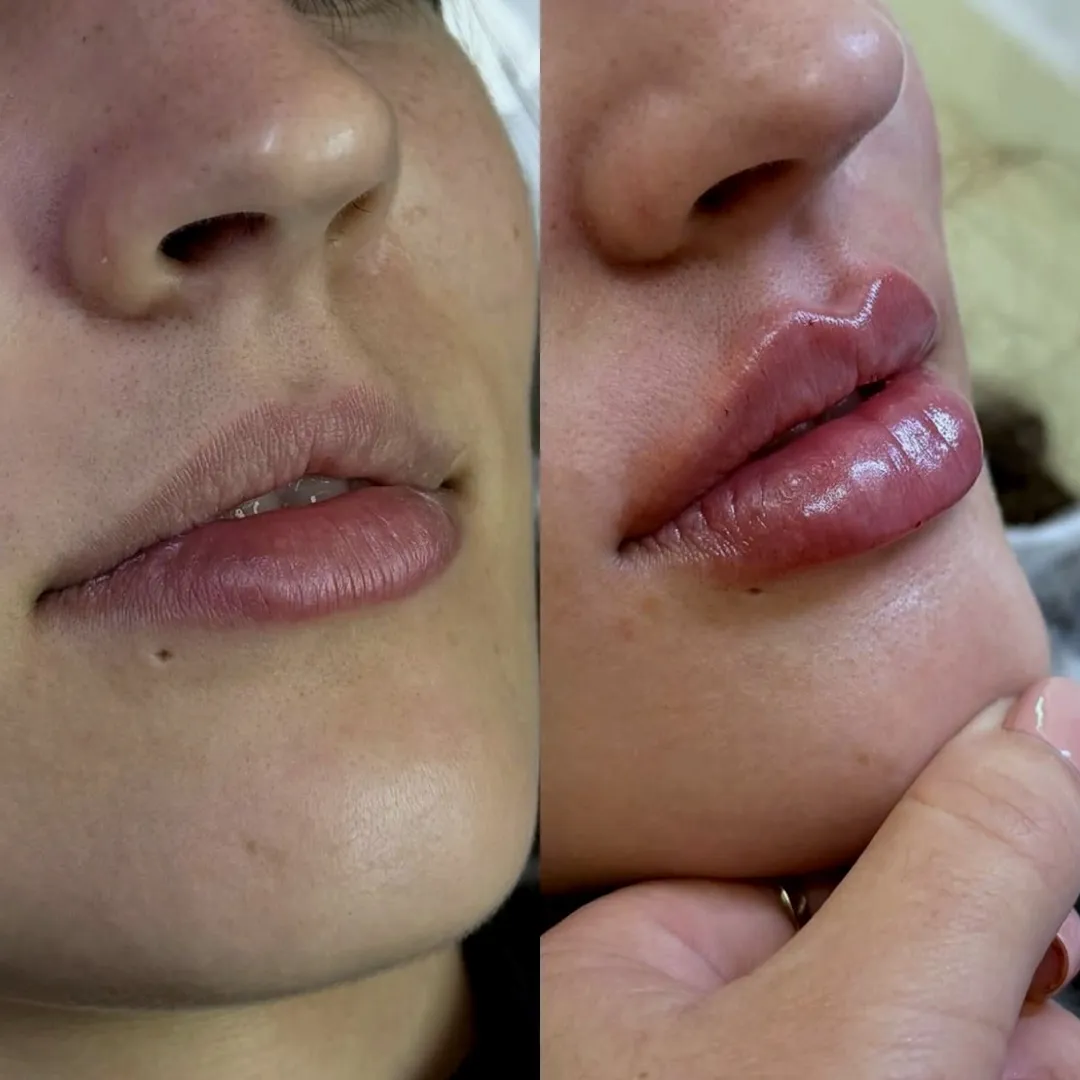 Preenchimento labial