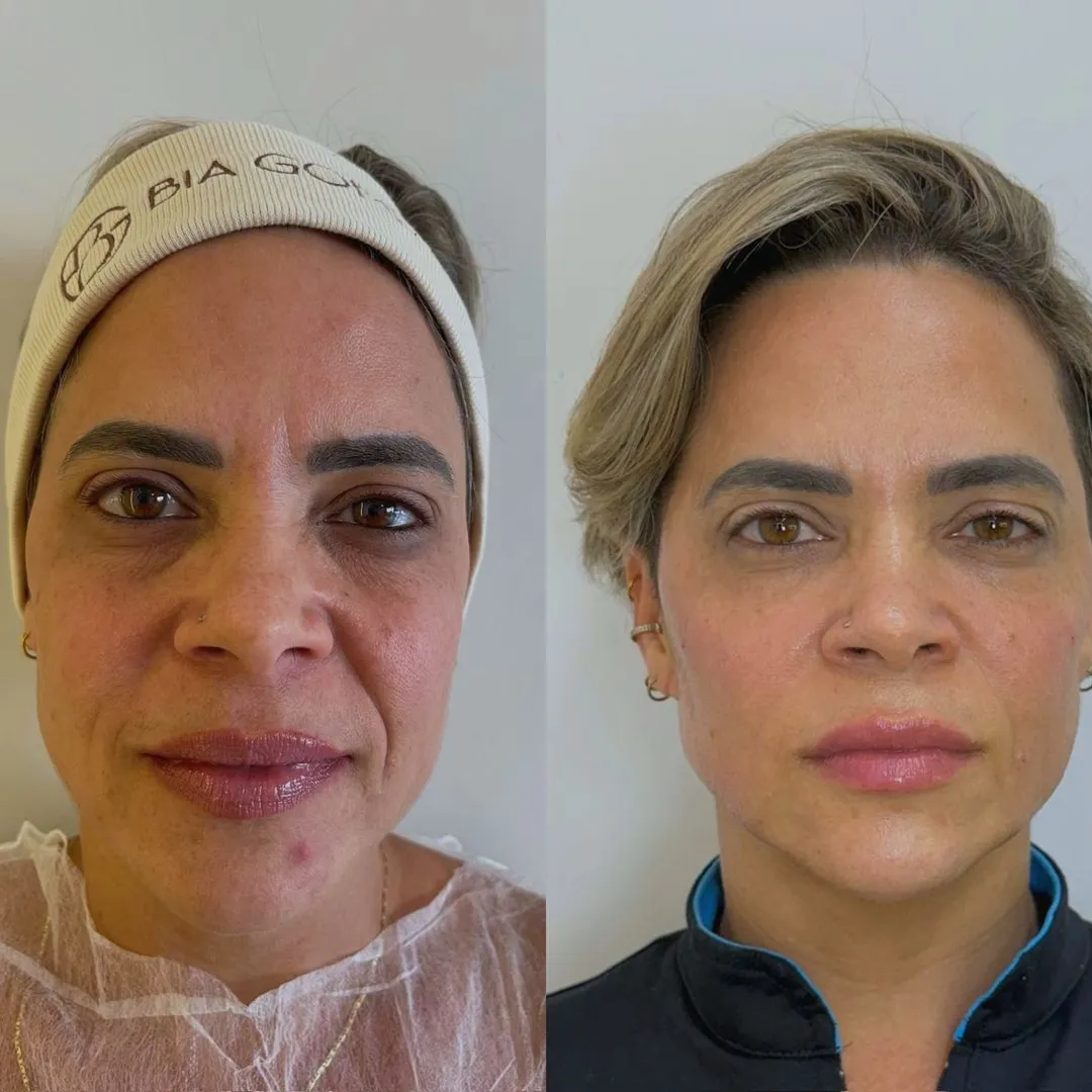 Harmonização de têmpora ou outra área da face