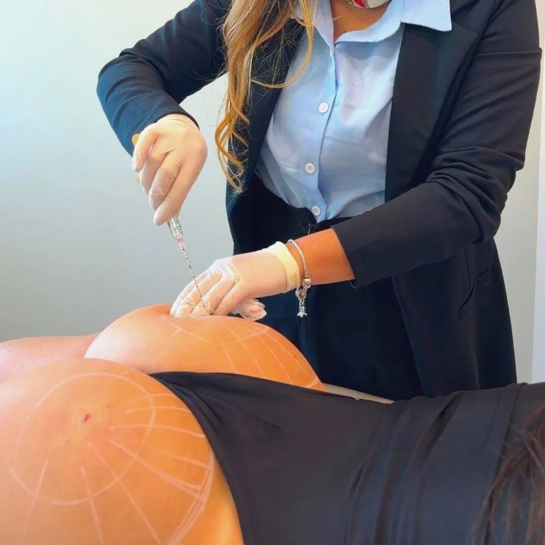 Bioestimulador de glúteo