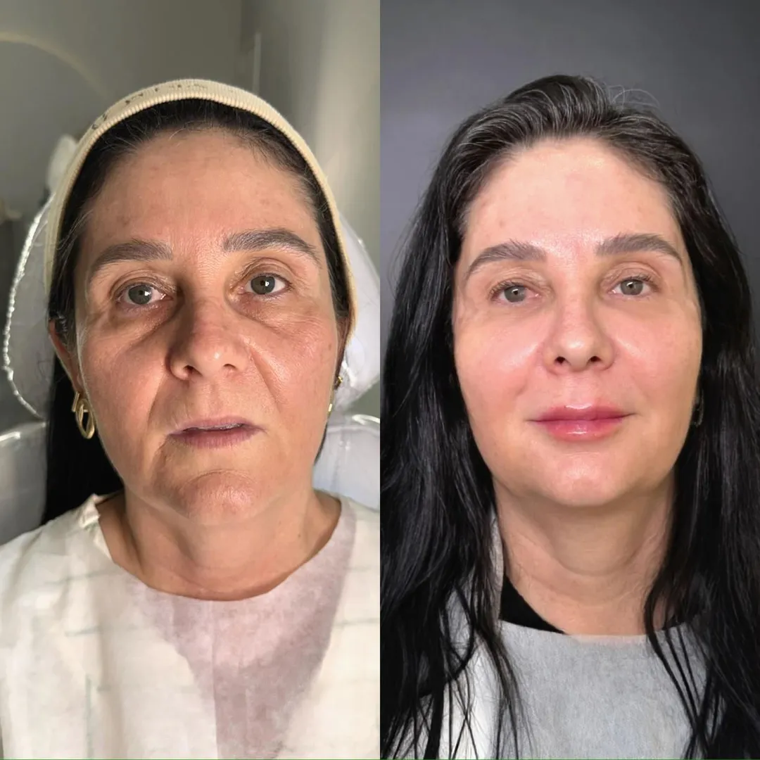 Harmonização facial